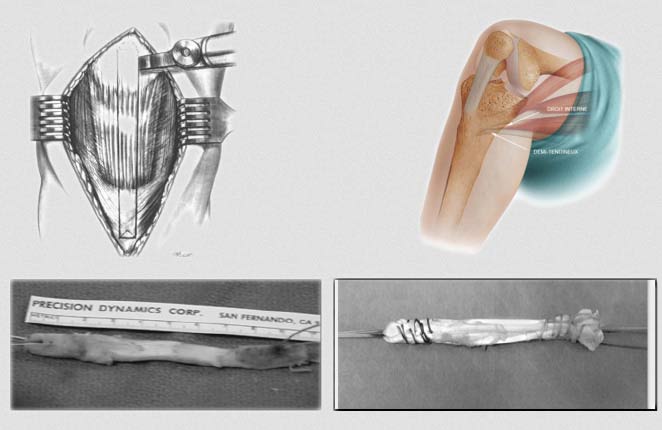 Sch&eacute;mas m&eacute;dicaux du ligament crois&eacute; et de l&rsquo;articulation du genou