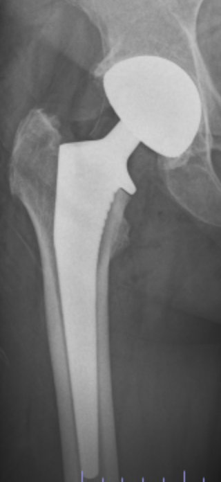 Radiographie de hanche avec proth&egrave;se totale implant&eacute;e