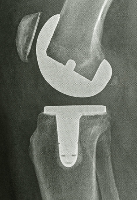 Radiographie du genou avec proth&egrave;se totale en place