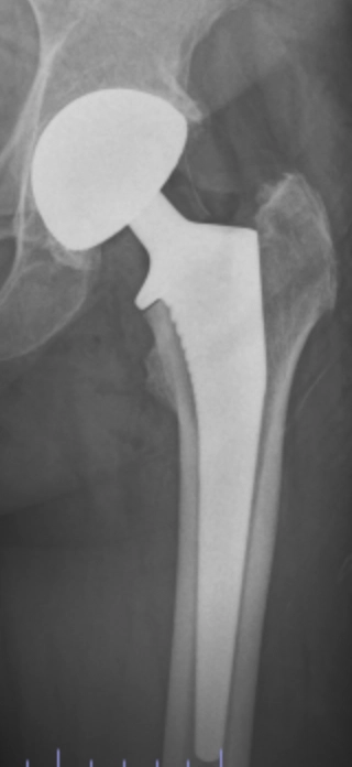 Radiographie d'une proth&egrave;se de la hanche