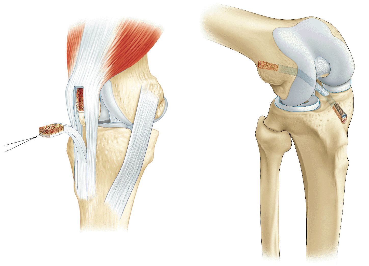 Shema ligaments croisés